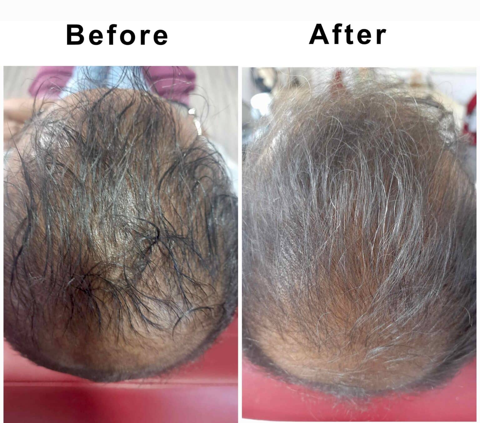 GFC PRP Hair Treatment for Hair Rejuvenating in Indiranagar Bangalore