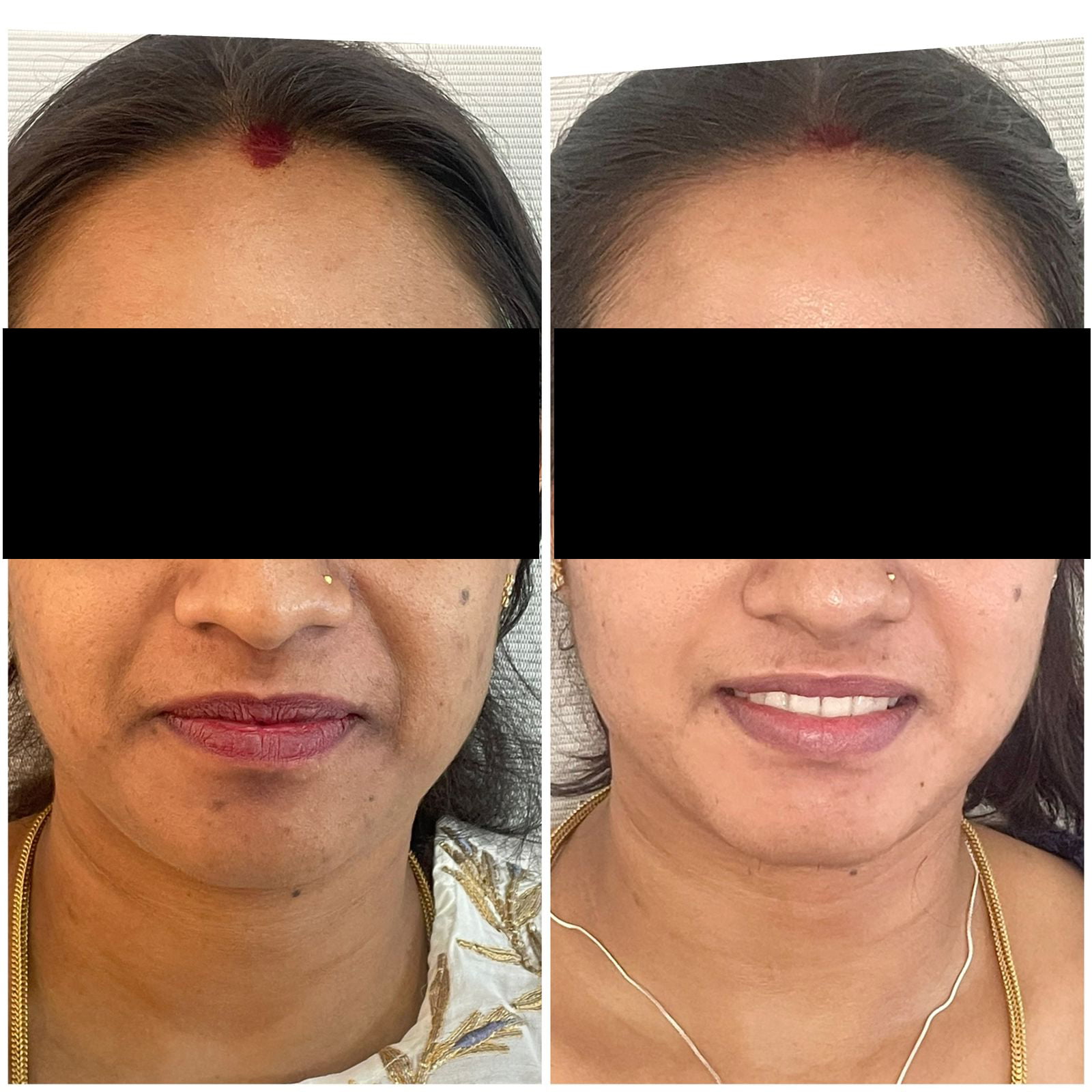 Advance Skin Lightening Whitening Treatment In Indiranagar Bangalore